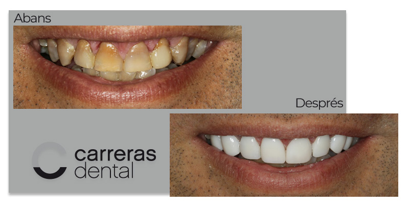 Cas Clínic Estètica Dental - Carreras Dental - Terrassa
