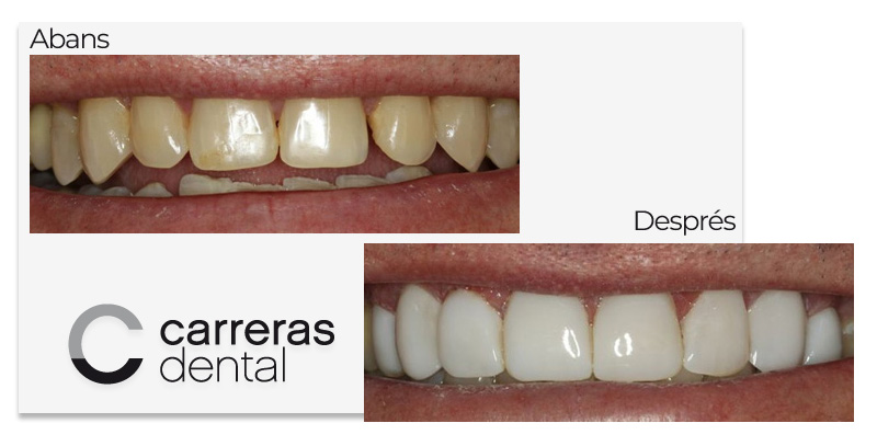 Cas Clínic Estètica Dental - Carreras Dental - Terrassa