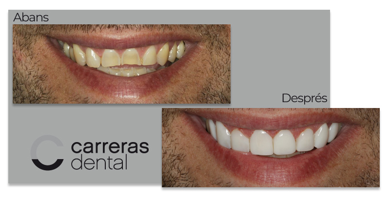 Cas Clínic Estètica Dental - Carreras Dental - Terrassa