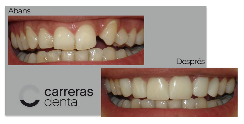 Cas Clínic Estètica Dental - Carreras Dental - Terrassa