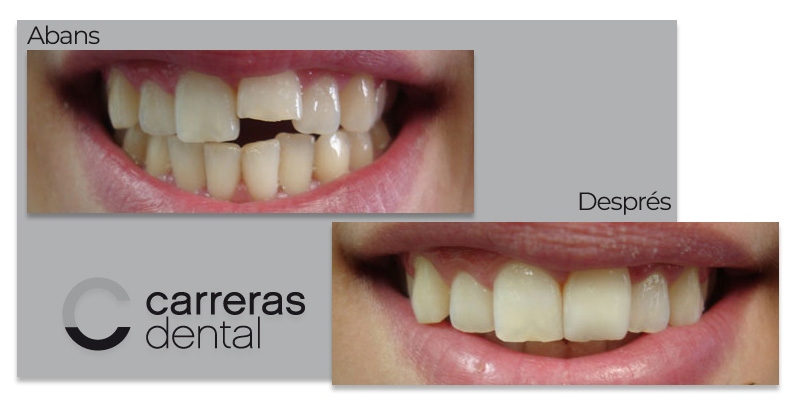 Cas Clínic Estètica Dental - Carreras Dental