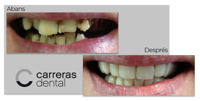 Cas Clínic Estètica Dental - Carreras Dental - Terrassa
