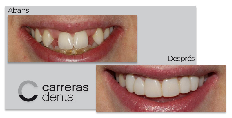 Cas Clínic Estètica Dental - Carreras Dental - Terrassa