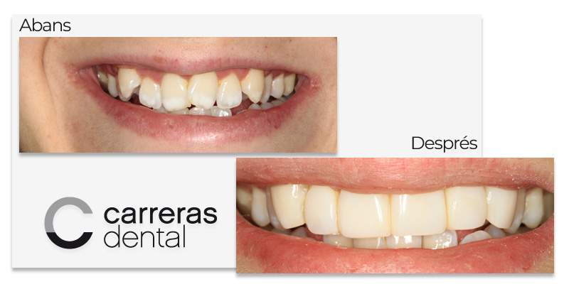 Cas Clínic Estètica Dental - Carreras Dental - Terrassa