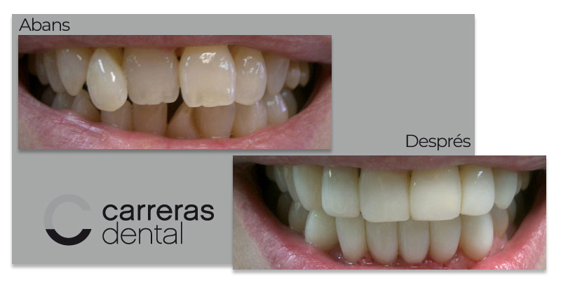 Cas Clínic Estètica Dental - Carreras Dental - Terrassa