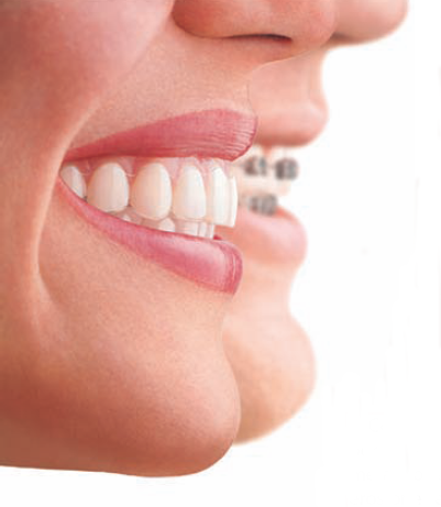 Ortodoncia Brackets - Carreras Dental - Terrassa