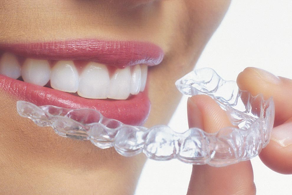 Ortodoncia Invisalign - Carreras Dental - Terrassa