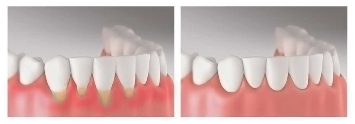 Periodoncia - Carreras Dental - Terrassa